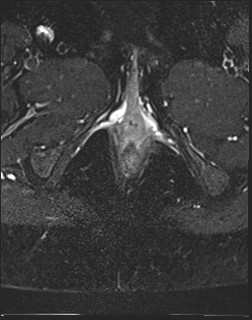 File:Adnexal multilocular cyst (O-RADS US 3- O-RADS MRI 3) (Radiopaedia 87426-103754 Axial T2 fat sat 28).jpg