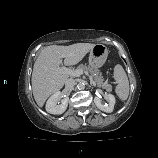 File:Adrenal collision tumor (ACT) (Radiopaedia 48462-53379 Axial C+ delayed 20).jpg