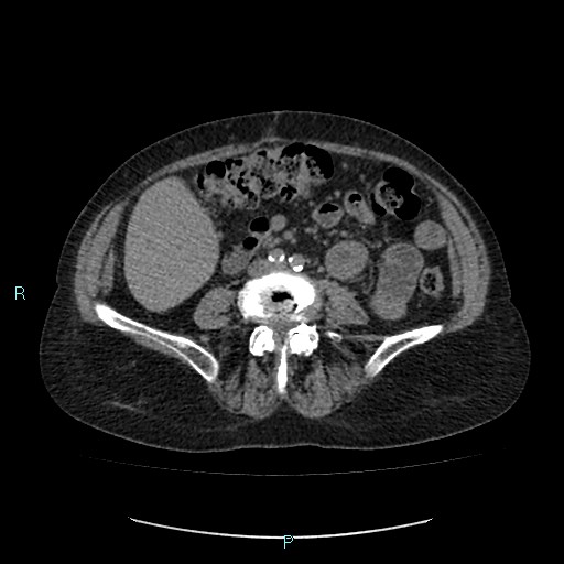 File:Adrenal collision tumor (ACT) (Radiopaedia 48462-53379 Axial non-contrast 35).jpg
