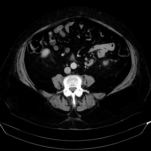 Adrenal cortical carcinoma (Radiopaedia 64017-72769 Axial C+ portal venous phase 41).jpg