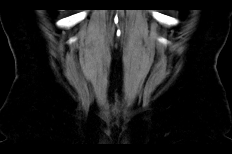 Adrenal cortical carcinoma (Radiopaedia 64017-72769 Coronal non-contrast 53).jpg