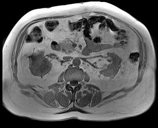 File:Adrenal cortical carcinoma (Radiopaedia 64017-72770 Axial T1 in-phase 41).jpg