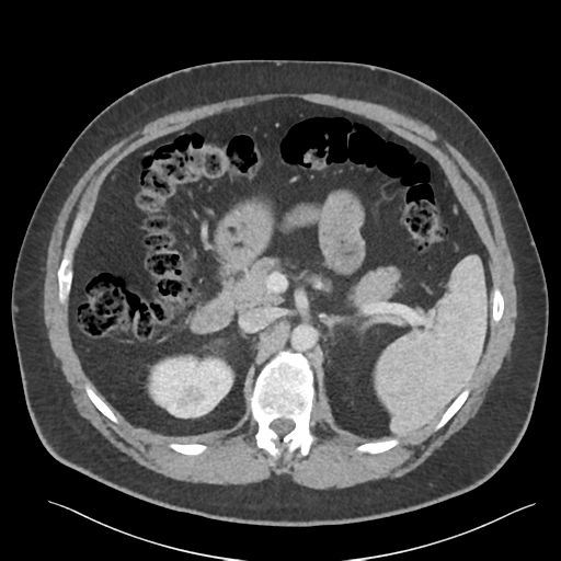 File:Adrenal cyst (Radiopaedia 45625-49777 Axial C+ portal venous phase 38).png
