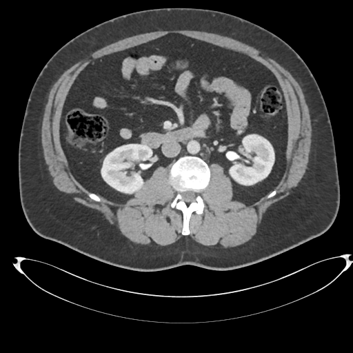 File:Adrenal cyst (Radiopaedia 45625-49778 AXIAL THICK 60 sec 44).png