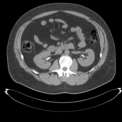 Adrenal cyst (Radiopaedia 45625-49778 Axial non-contrast 51).png