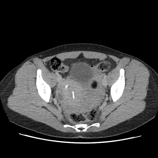 Adrenal cyst (Radiopaedia 64869-73813 Axial C+ portal venous phase 68).jpg