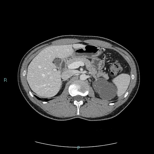 Adrenal cystic lymphangioma (Radiopaedia 83161-97534 Axial C+ portal venous phase 31).jpg