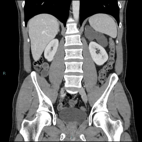 Adrenal cystic lymphangioma (Radiopaedia 83161-97534 Coronal C+ portal venous phase 46).jpg