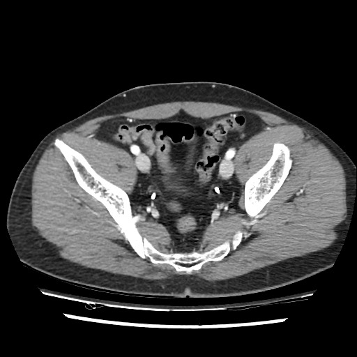 File:Adrenal gland trauma (Radiopaedia 81351-95078 Axial Dual bolus trauma C+ 108).jpg