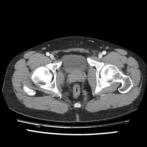 Adrenal gland trauma (Radiopaedia 81351-95078 Axial Dual bolus trauma C+ 118).jpg