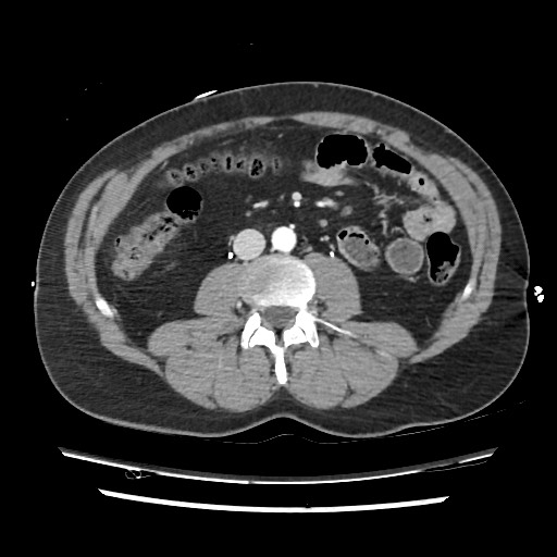 File:Adrenal gland trauma (Radiopaedia 81351-95078 Axial Dual bolus trauma C+ 81).jpg