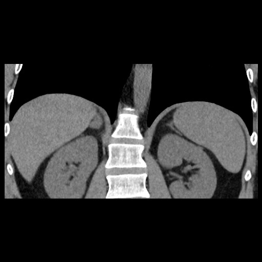 Adrenal gland trauma (Radiopaedia 81351-95079 Coronal non-contrast 59).jpg