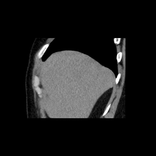Adrenal gland trauma (Radiopaedia 81351-95079 Sagittal non-contrast 14).jpg