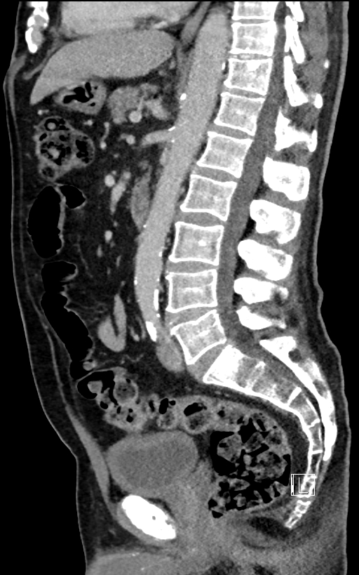Adrenal lymphoma (Radiopaedia 73730-84529 Sagittal C+ portal venous phase 60).jpg