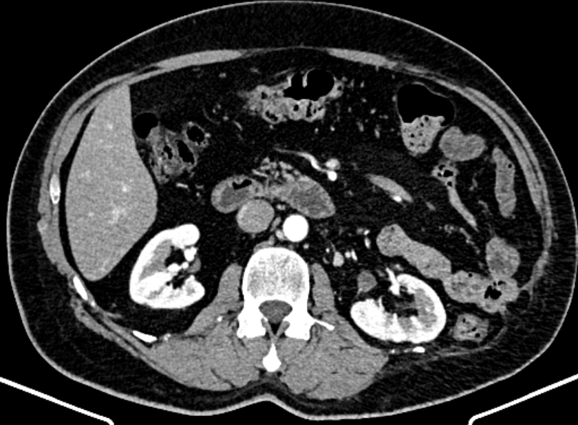 Adrenal metastases (Radiopaedia 73082-83791 Axial C+ arterial phase 77).jpg