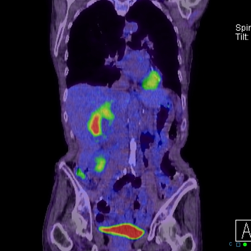 File:Adrenal metastasis from small cell lung cancer (Radiopaedia 19133-19109 Coronal 14).jpg