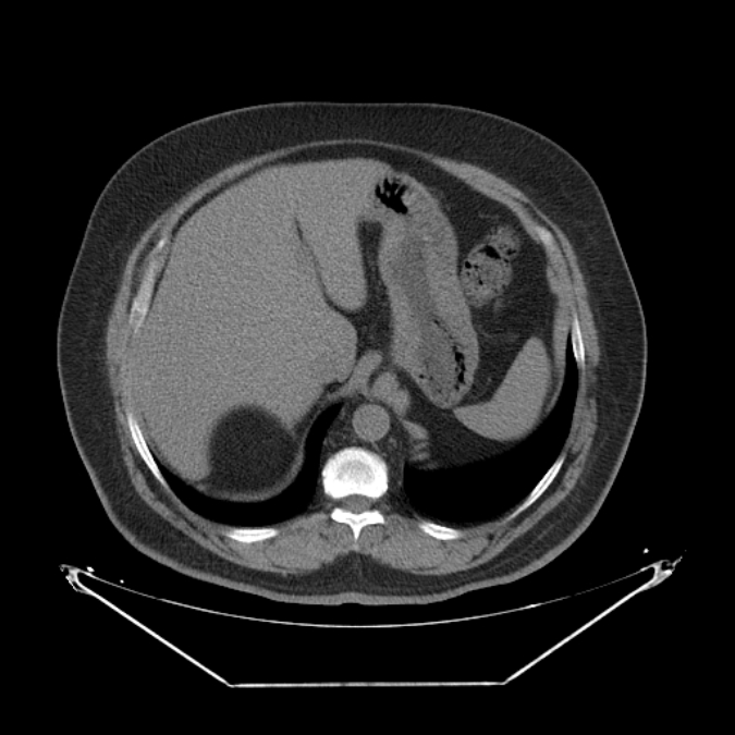 Adrenal myelolipoma (Radiopaedia 26278-26407 Axial non-contrast 11).jpg