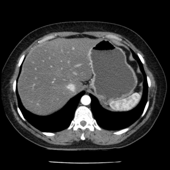 Adrenal myelolipoma (Radiopaedia 43401-46759 Axial C+ arterial phase 15).jpg
