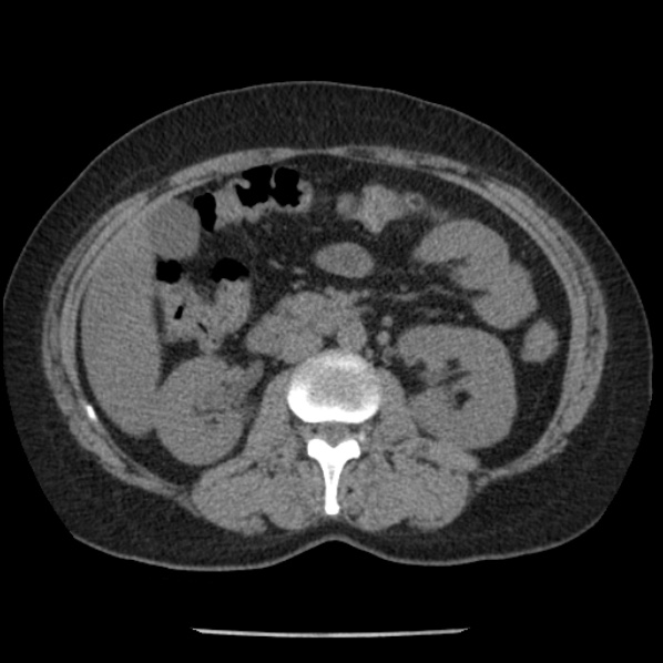 Adrenal myelolipoma (Radiopaedia 43401-46759 Axial non-contrast 39).jpg
