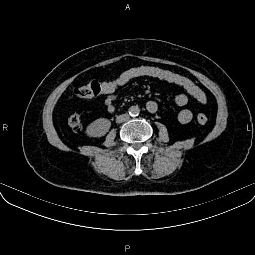 Adrenal myelolipoma (Radiopaedia 82742-96986 Axial non-contrast 92).jpg
