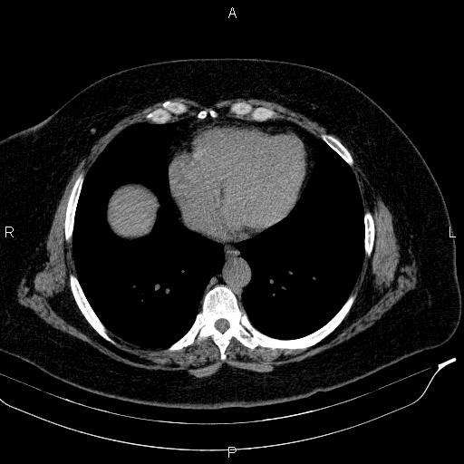 File:Adrenal myelolipoma (Radiopaedia 84319-99617 Axial With oral contrast 15).jpg