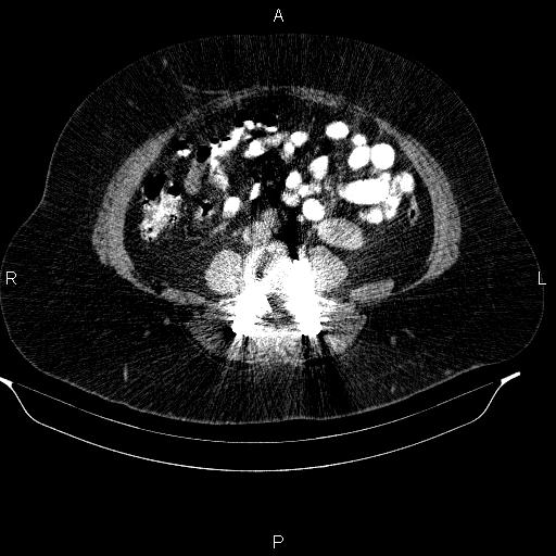 File:Adrenal myelolipoma (Radiopaedia 84319-99617 Axial renal cortical phase 68).jpg