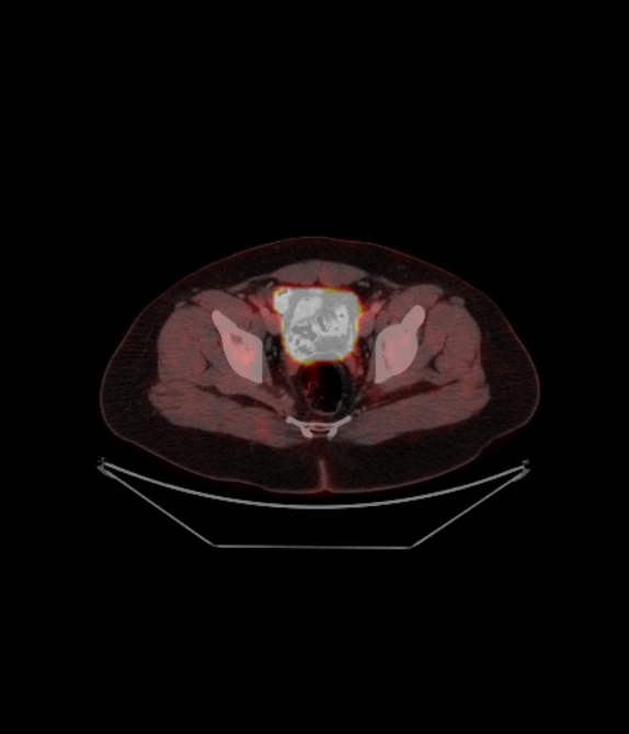 Adrenocortical carcinoma (Radiopaedia 80134-93440 ِAxial 240).jpg