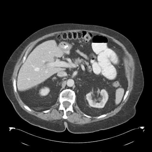 Adult ileal intussusception with secondary obstruction (Radiopaedia 30395-31051 Axial C+ portal venous phase 23).jpg
