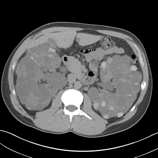 File:Adult polycystic kidney disease (Radiopaedia 47866-52626 Axial non-contrast 33).png