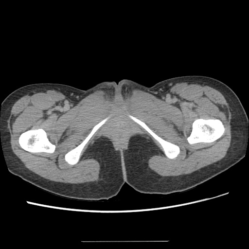Adult polycystic kidney disease (Radiopaedia 48845-53876 Axial renal excretory phase 104).jpg