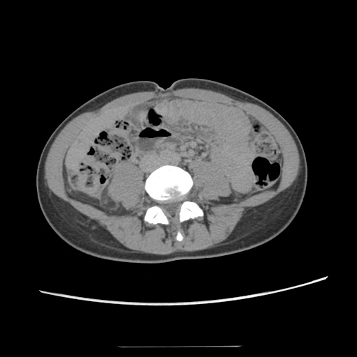 Adult polycystic kidney disease (Radiopaedia 48845-53876 Axial renal excretory phase 56).jpg