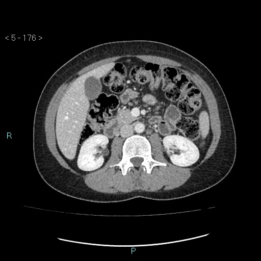 Adult transient intestinal intussusception (Radiopaedia 34853-36310 Axial C+ portal venous phase 27).jpg