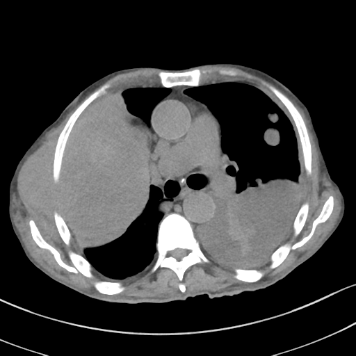 Advanced metastatic lung cancer (Radiopaedia 48910-53954 Axial non-contrast 30).png