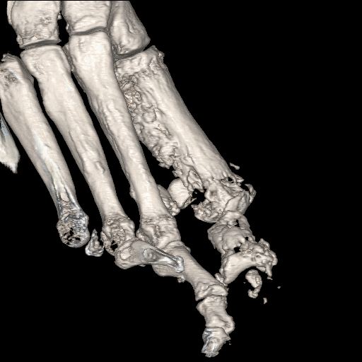 File:Advanced osteomyelitis due to open metatarsal fracture (Radiopaedia 83891-99095 VRT 16).jpg