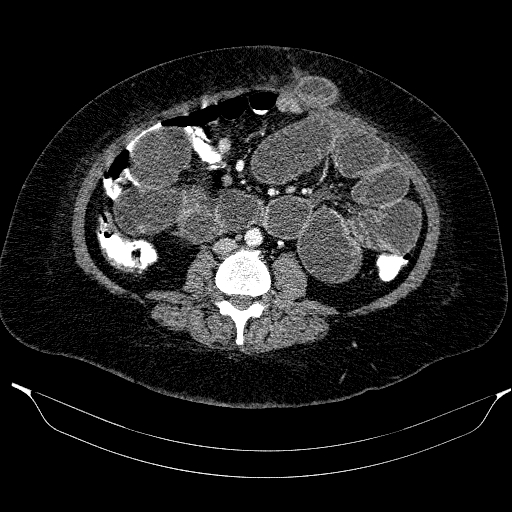 File:Afferent loop syndrome - secondary to incarcerated trocar site hernia (Radiopaedia 82959-97305 Axial C+ portal venous phase 133).jpg