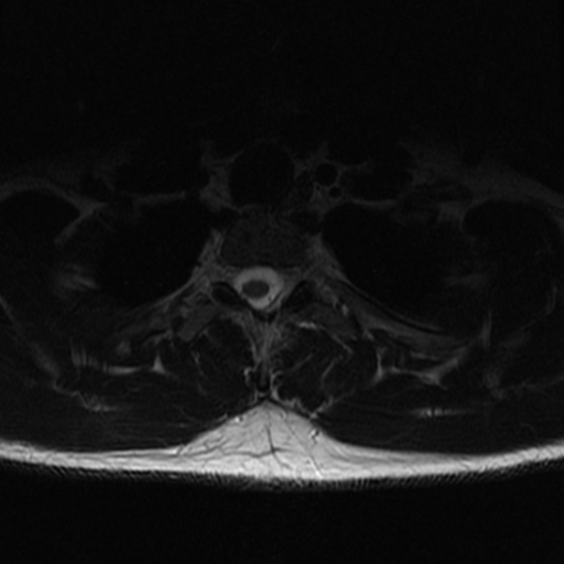 File:Aggressive vertebral hemangioma (Radiopaedia 39937-42404 Axial T2 37).png