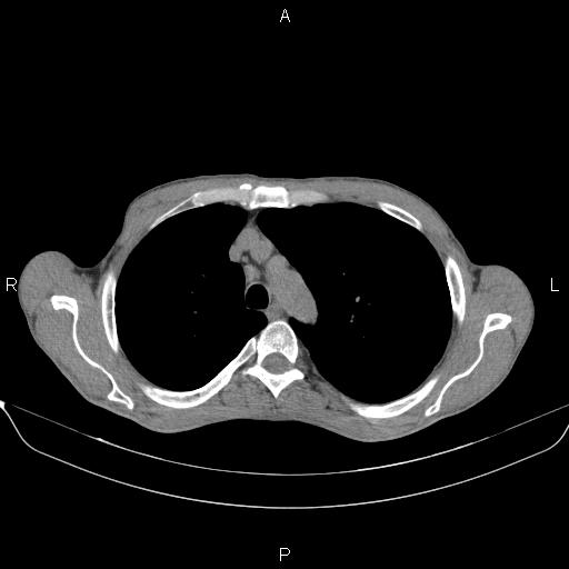 Air bronchogram in pneumonia (Radiopaedia 85719-101512 Axial non-contrast 18).jpg