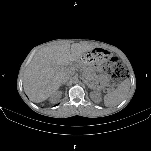 Air bronchogram in pneumonia (Radiopaedia 85719-101512 Axial non-contrast 71).jpg