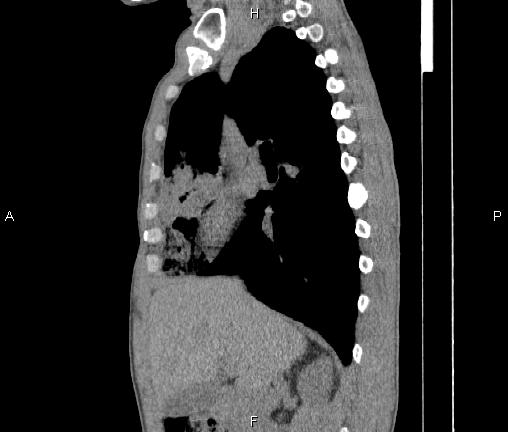 File:Air bronchogram in pneumonia (Radiopaedia 85719-101512 F 37).jpg
