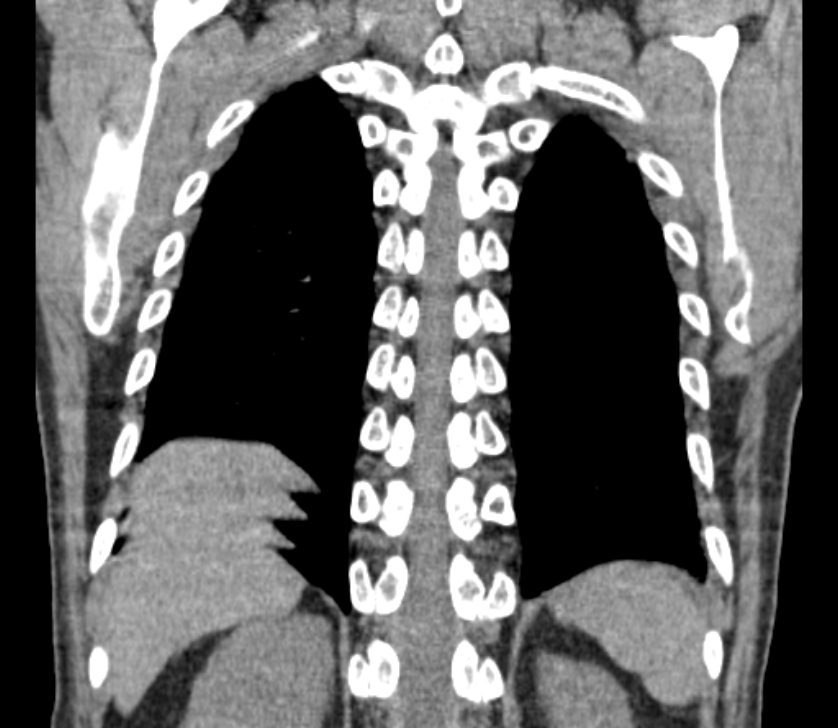 Airway foreign body in adult (Radiopaedia 85907-101779 Coronal liver window 228).jpg