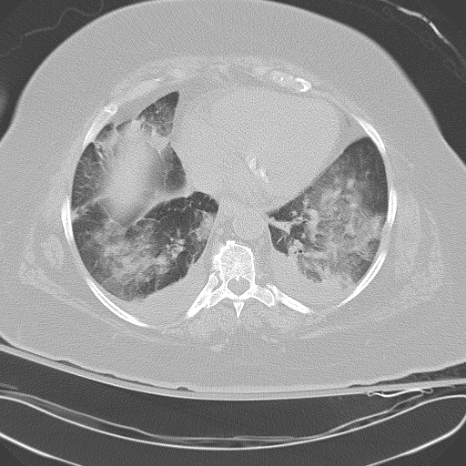 All trans retinoic acid (ATRA) syndrome (Radiopaedia 38212-40229 Axial lung window 39).jpg