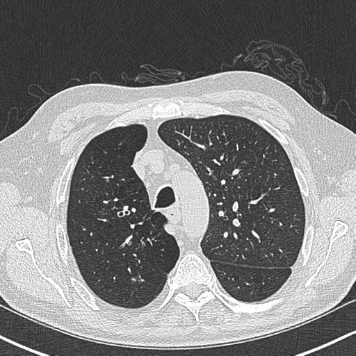 File:Allergic bronchopulmonary aspergillosis (Radiopaedia 44760-48571 Axial lung window 19).png
