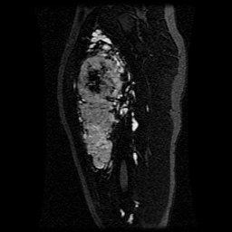 Alveolar soft part sarcoma (Radiopaedia 64501-73678 D 79).jpg