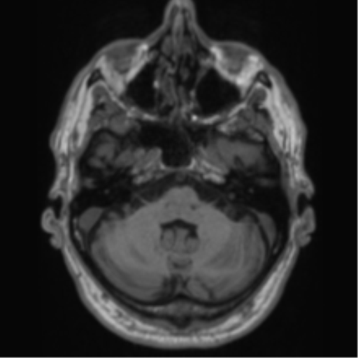Alzheimer's disease- with Gerstmann syndrome and dressing apraxia (Radiopaedia 54882-61150 Axial T1 16).png