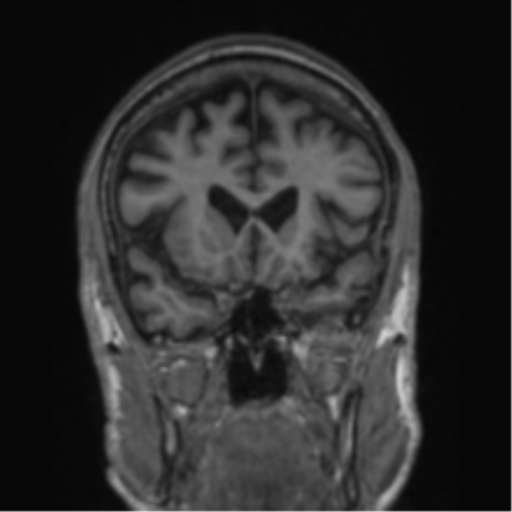 File:Alzheimer's disease- with apraxia (Radiopaedia 54763-61011 Coronal T1 64).png