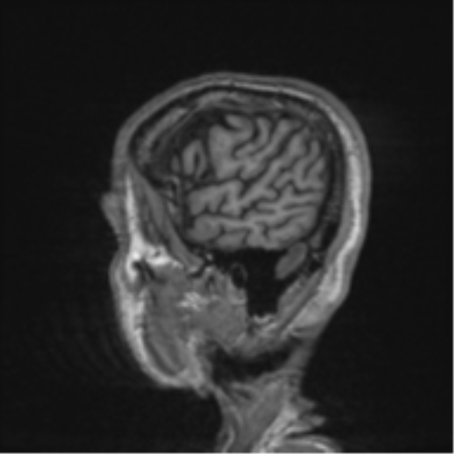 File:Alzheimer's disease- with apraxia (Radiopaedia 54763-61011 Sagittal T1 63).png