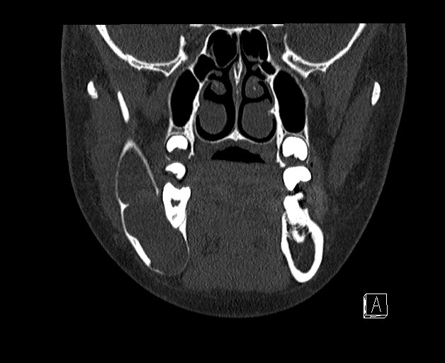 File:Ameloblastoma (Radiopaedia 26645-26793 bone window 6).jpg