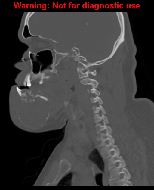Ameloblastoma (Radiopaedia 33126-34164 Sagittal bone window 46).jpg