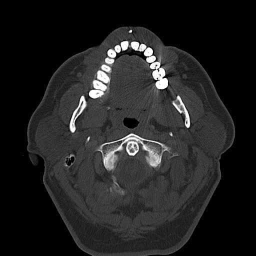 Ameloblastoma (Radiopaedia 38520-40623 Axial bone window 24).png