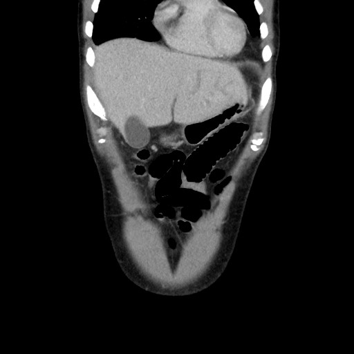 Amoebic liver abscesses (Radiopaedia 55536-62009 B 13).jpg
